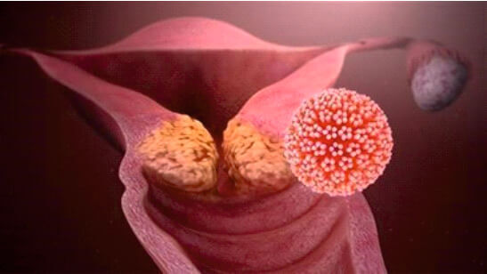 Cancro al collo dell'utero e virus HPV (ingrandito). Credits: Manu5, Licence Creative Commons